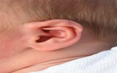 Cera no ouvido