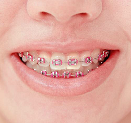 História dos Aparelhos Dentários