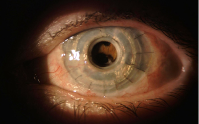 Pesquisadores brasileiros desenvolvem 1ª córnea artificial 100% nacional